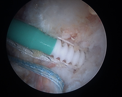 Endoscopic Abductor Tendon Repair